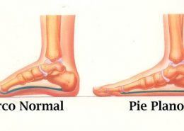 pies planos