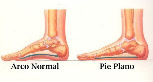 pies planos
