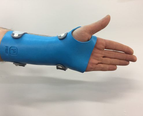 Impresión 3D ferula mano-muñeca