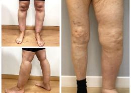 ¿Cómo diferenciar lipedema y linfedema?