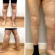 ¿Cómo diferenciar lipedema y linfedema?