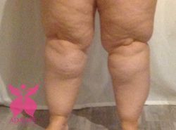 Lipedema Adalipe